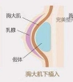 假体隆胸会不会移位?如何防止假体隆胸移位?