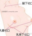 假体隆胸会留疤吗?切口有哪些?能给我详细介绍下吗?