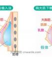 隆胸后还可以哺乳吗