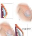 隆胸术后假体移位做修复是不是比做手术的伤害性要大?