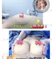 隆胸时该如何选假体?