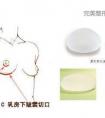 哪些人适合做假体隆胸手术?乳房下皱襞切口会留疤吗?