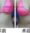 泉州假体丰胸会不会变形