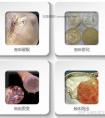 为什么隆胸10年后必须做全面检查,什么原因造成假体破裂!