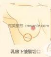 怎么判断隆胸假体移位?上移或下滑还能做修复手术吗