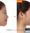 硅胶假体隆鼻前后对比效果图片