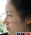 硅胶假体隆鼻取出过程,2个月恢复效果对比图。
