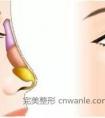 国产威宁假体隆鼻好吗?和膨体隆鼻的区别是什么?