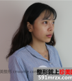鼻部整形假体隆鼻,垫鼻梁塑造侧面美颜