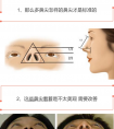 害怕假体隆鼻有风险,只需做项鼻尖整形也能改变效果哦