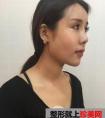 哈尔滨伊美尔隆鼻假体取出|附价格表案例效果对比图分享~