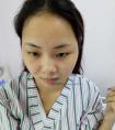和大家分享一下我做假体隆鼻的恢复过程