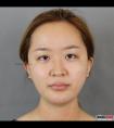 假体隆鼻+耳软骨垫鼻尖效果对比图,亲身经历分享