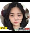 韩国生科假体隆鼻+耳软骨垫鼻尖两个月恢复效果照片分享~