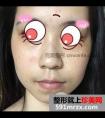 韩式生科二段式假体隆鼻真实分享,价格实惠效果自然!