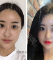 韩国隆鼻假体I型和L型哪种好?为什么L假体现在都不怎么用了