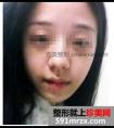 膨体假体隆鼻前后对比效果图片及恢复过程