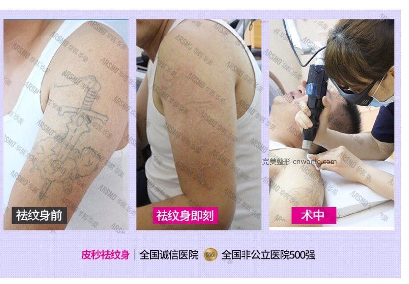 怎么清洗纹身,激光洗纹身能洗干净吗,会不会留疤?激光