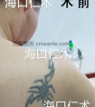 皮秒激光洗纹身一般需几次可以洗干净?海口洗纹身多少钱