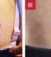 激光洗纹身洗的干净吗 洗纹身痛不痛呢 (2)