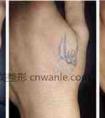 激光洗纹身能洗干净吗 告别幼稚纹身
