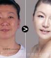 玻尿酸除皱针多长时间打一次