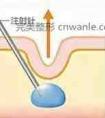 面部注射玻尿酸后能达到一个什么样的效果?