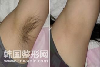 冰点<a href='/tag_tuomao16.html'>脱毛</a>脱腋毛疼吗 皮肤黑会很疼对吗？