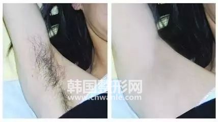 冰点<a href='/tag_tuomao16.html'>脱毛</a>