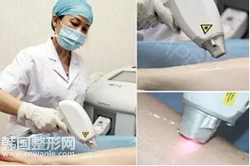 脸上做激光脱毛多少钱一次?效果好吗?