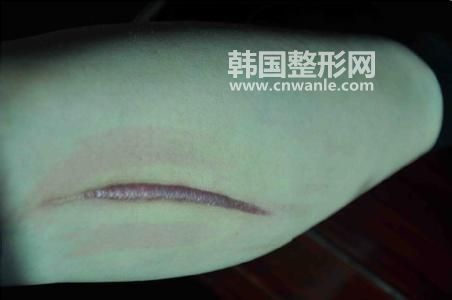 疤痕增生多久可以变平能慢慢消失吗?