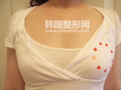 <a href='/tag_jiati95.html'>假体</a>丰胸有什么副作用?