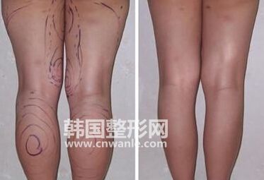 小腿<a href='/tag_xizhijianfei25.html'>吸脂减肥</a>术后皮肤为什么会变硬？