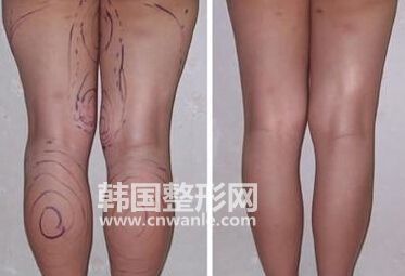 小腿吸脂减肥术后皮肤为什么会变硬?