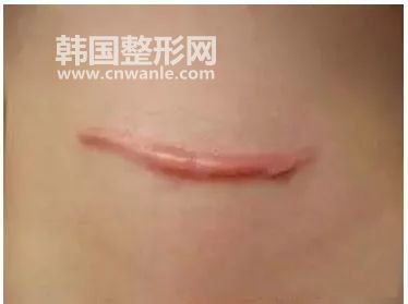 修复手术<a href='/tag_bahen21.html'>疤痕</a>的方法?