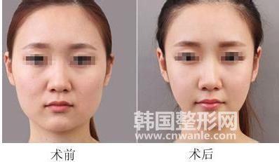 面部<a href='/tag_xizhi74.html'>吸脂</a>后遗症有哪些？