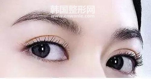 如何正确选择适合自己的双眼皮方式？