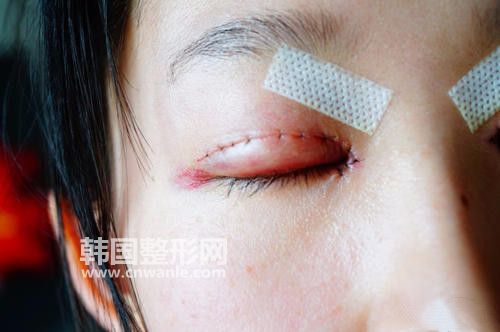 请问做<a href='/tag_maixian35.html'>埋线</a><a href='/tag_shuangyan108.html'>双眼</a>皮注意事项有哪些?