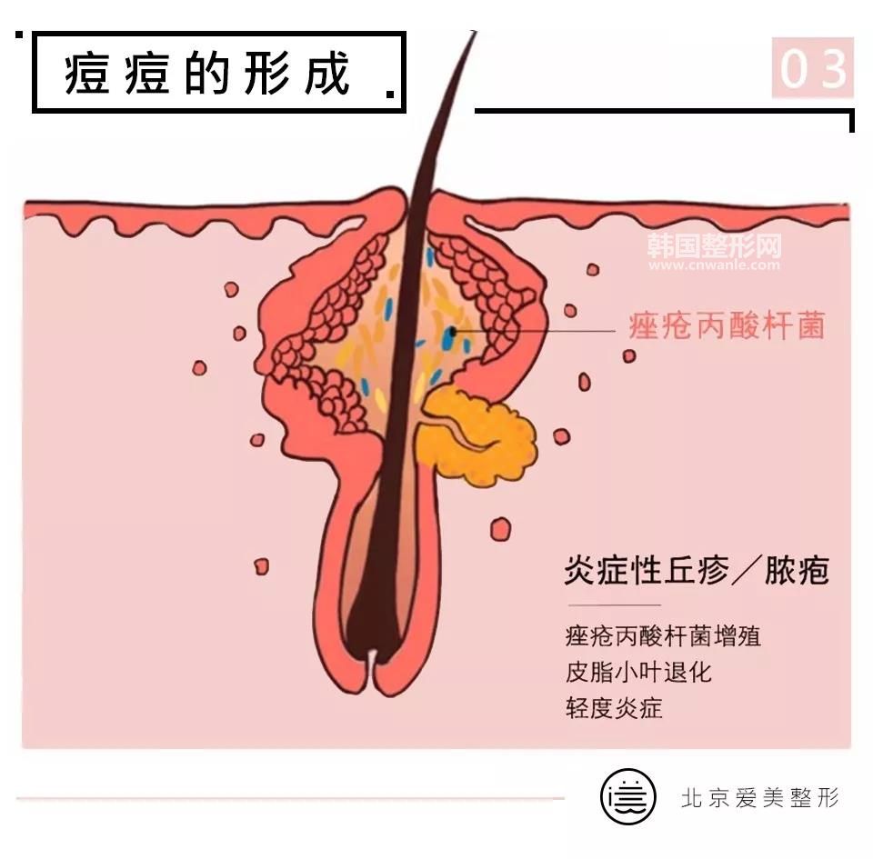 长痘图片以及相关原因图片