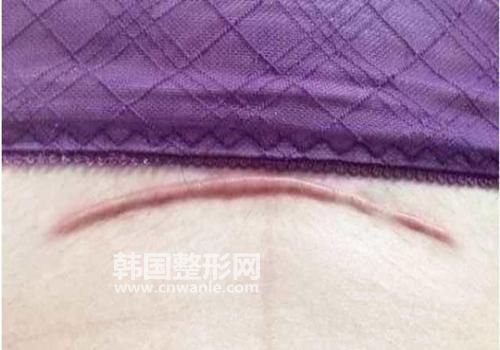 我生过孩子已经几个月了，当时生孩子的时候，我选择了剖腹产，现在刀疤的位置出现了增生的情况，现在我想问下医生，<a href='/tag_bahenzengsheng.html'>疤痕增生</a>最好的治疗方法?