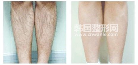 激光脱毛的危害和副作用有哪些?