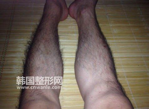 激光<a href='/tag_tuomao16.html'>脱毛</a>后还会不会再长?