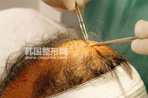 <a href='/tag_maofayizhi6.html'>毛发移植</a>费用