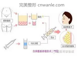 脂肪移植术后如何防止并发症及提高成活率?
