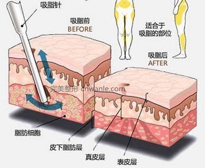 <a href='/tag_xizhi74.html'>吸脂</a>手术的危害和后遗症