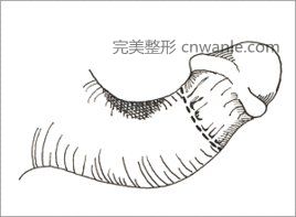 <a href='/tag_yinjingzengcu.html'>阴茎增粗</a>术是什么？适合哪些人群？