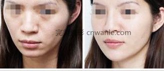 <a href='/tag_boniaosuantianchong7.html'>玻尿酸填充</a>面颊