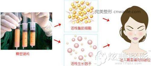 注射自体脂肪<a href='/tag_fenglianjia.html'>丰脸颊</a> 注射<a href='/tag_zitizhifangfeng.html'>自体脂肪丰脸</a>颊