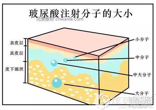 面部<a href='/tag_suxing.html'>塑形</a>采用中、大分子<a href='/tag_boniaosuanxiaoguo.html'>玻尿酸效果</a>明显 <a href='/tag_mianbusuxing.html'>面部塑形</a>采用中、<a href='/tag_dafenziboniao.html'>大分子玻尿酸</a>效果明显