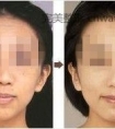 玻尿酸丰脸颊效果好吗